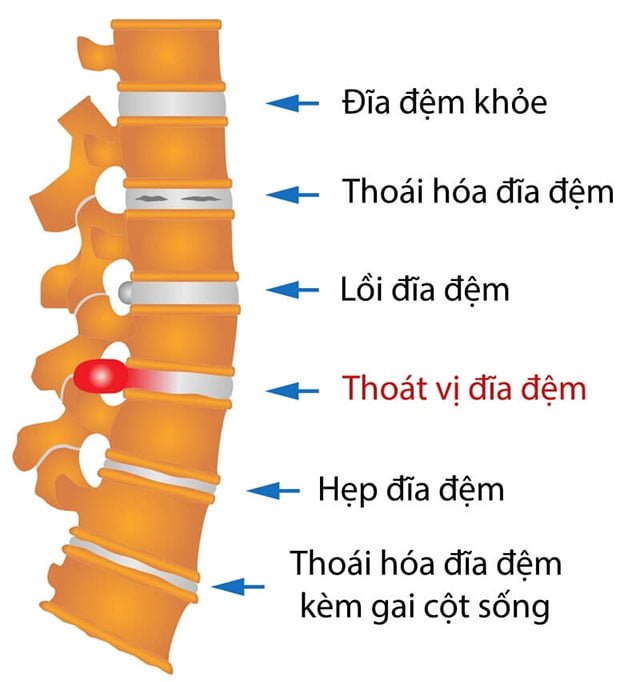 Tìm hiểu bệnh thoát vị đĩa đệm