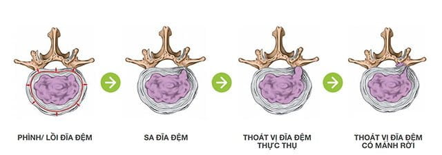 Các giai đoạn phát triển bệnh thoát vị đĩa đệm