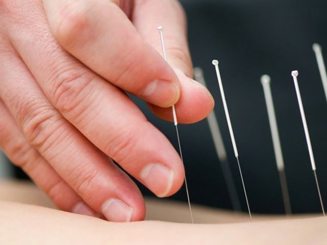 Châm cứu giúp bạn ngủ ngon hơn