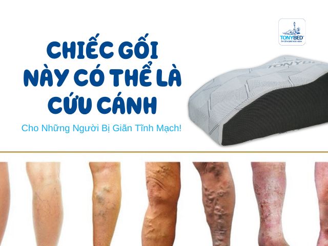 Gối chống suy giãn tĩnh mạch có thực sự tốt không